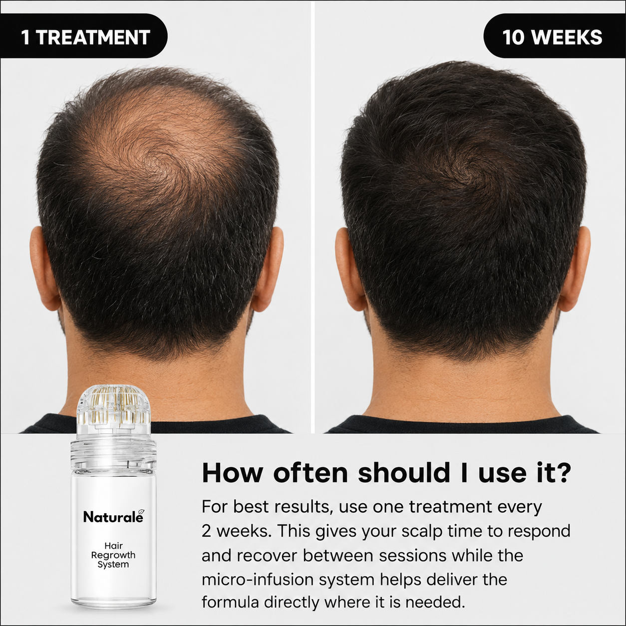 Hair Regrowth System Scalp Stamping Ritual